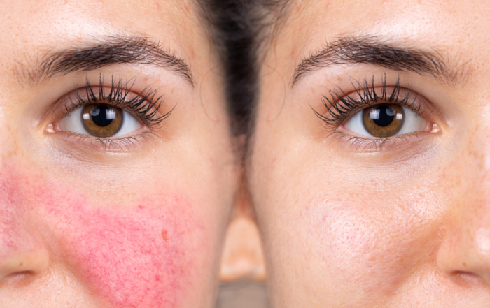 rosacea_rectangular